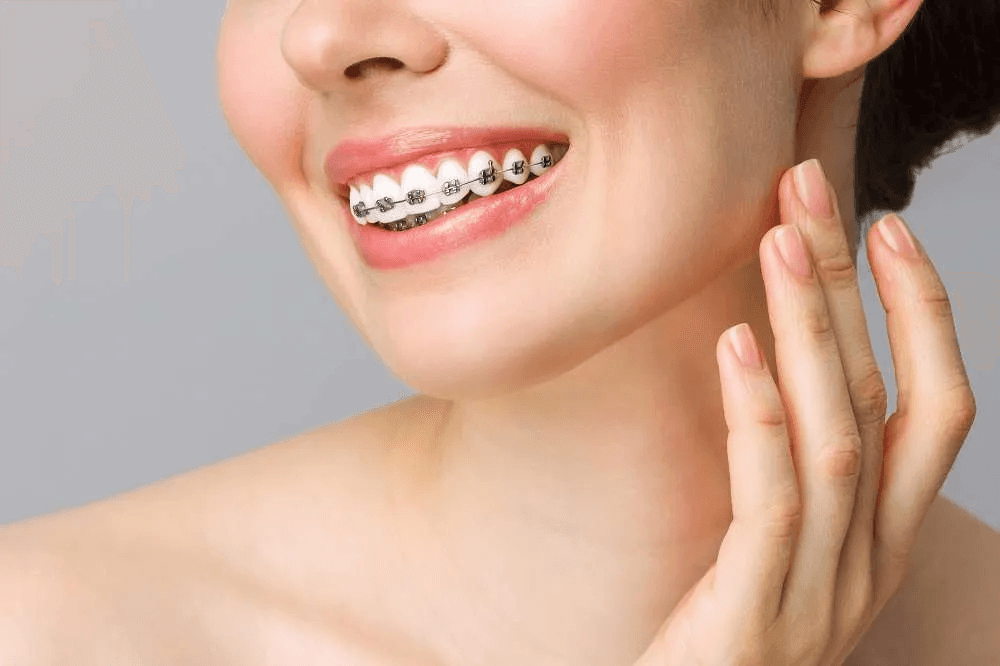 Dental Braces: The Complete Guide to Straightening Your Smile and Achieving the Confidence You Deserve