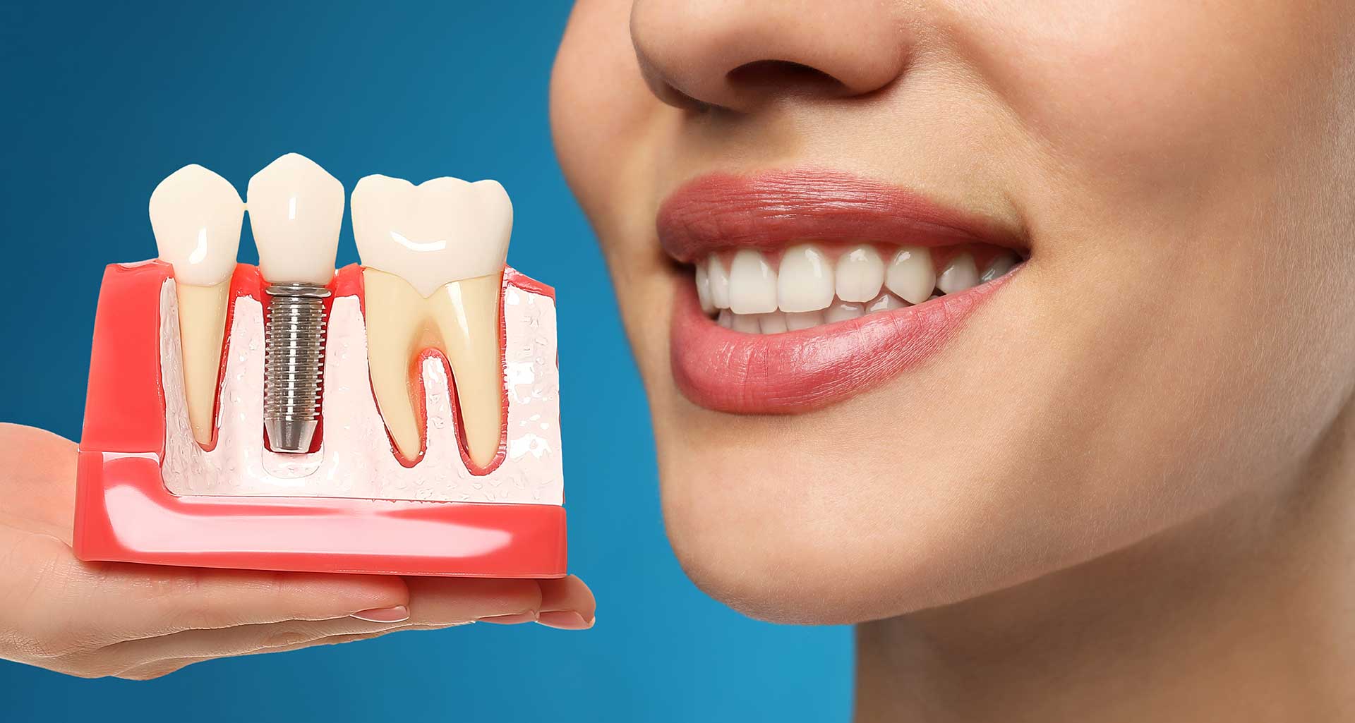 The Secret to Getting Your Smile Back: Everything You Need to Know About Dental Implants