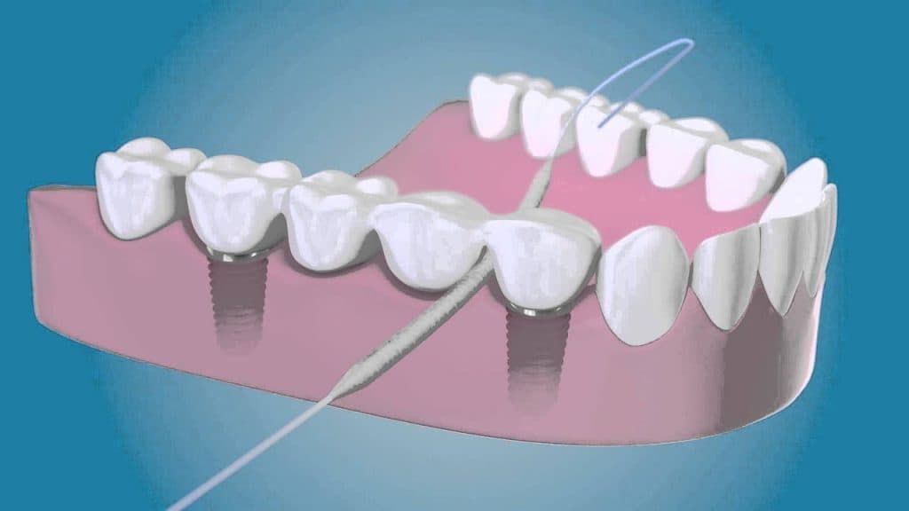 Proper Flossing Technique with Fixed Prosthesis