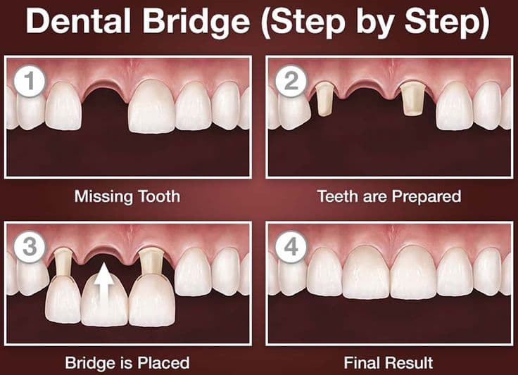 Fixed Prosthesis Placement Process