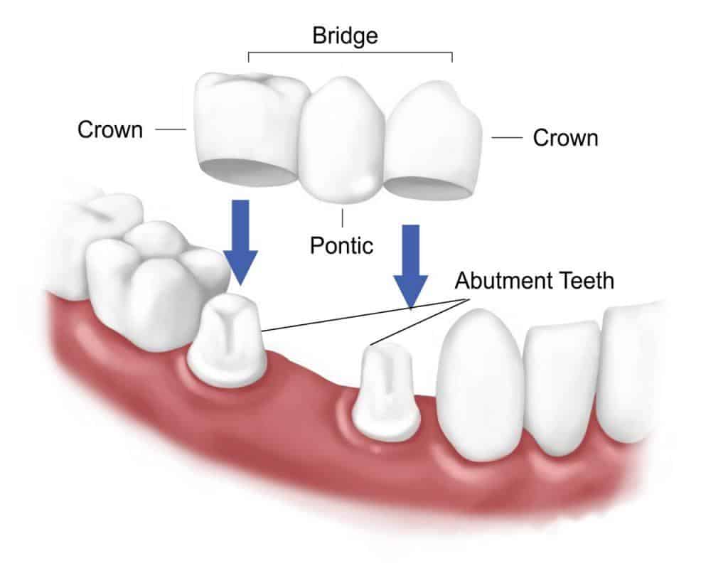 Fixed Dental Prosthesis Anatomy