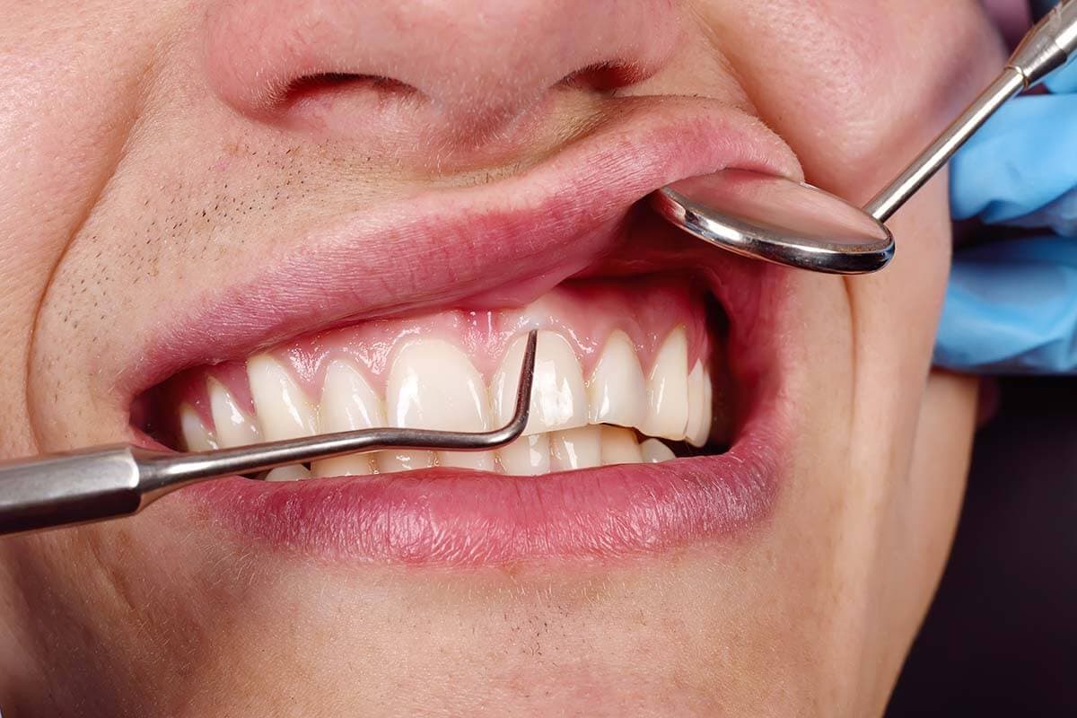 Gum Correction Treatment