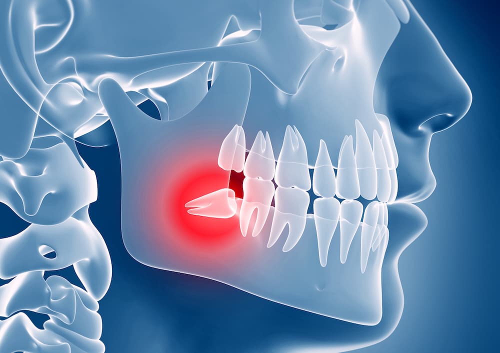 Wisdom Teeth Extraction: Your Complete Guide to Understanding the Procedure, Recovery, and Life After