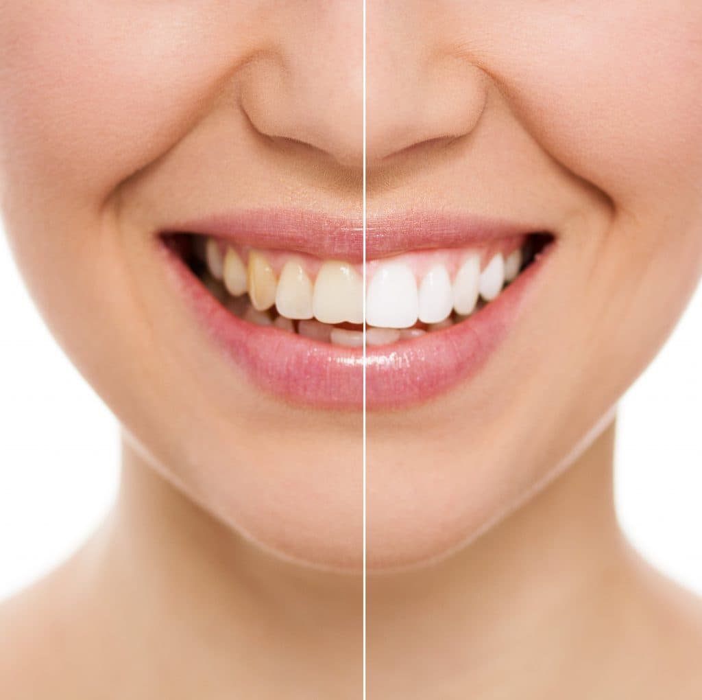 Cosmetic Dentistry Results