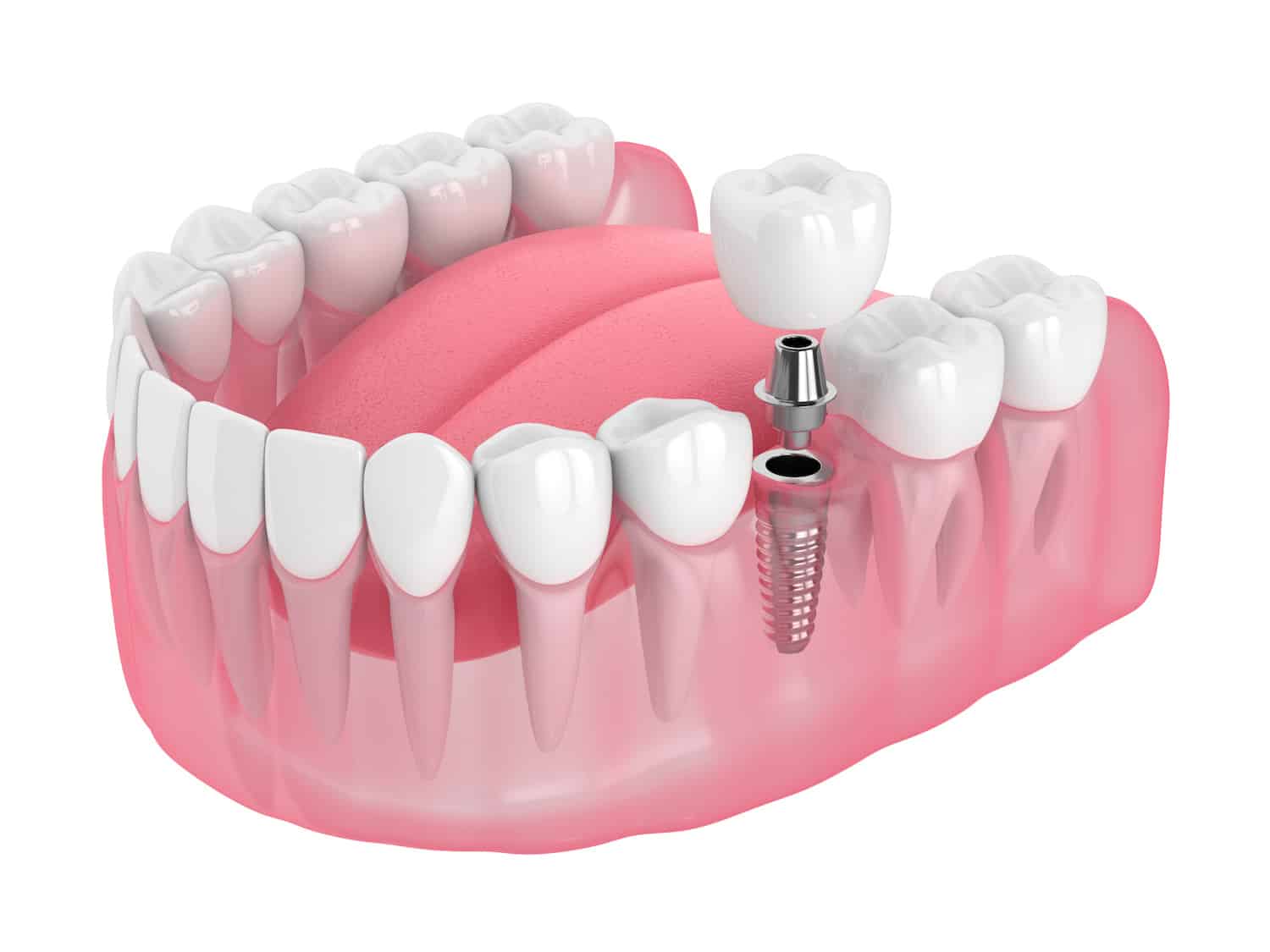 Dental Implants