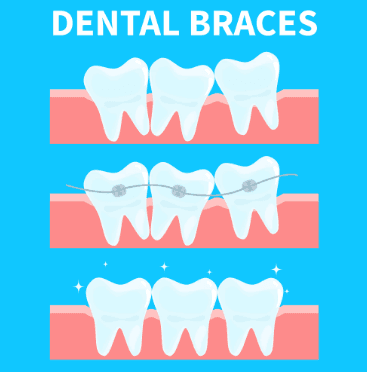 Orthodontic Treatment Progress