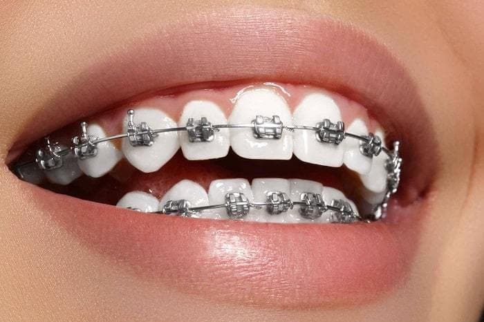 Happy Patient with Braces
