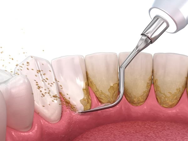 Professional Teeth Cleaning Process