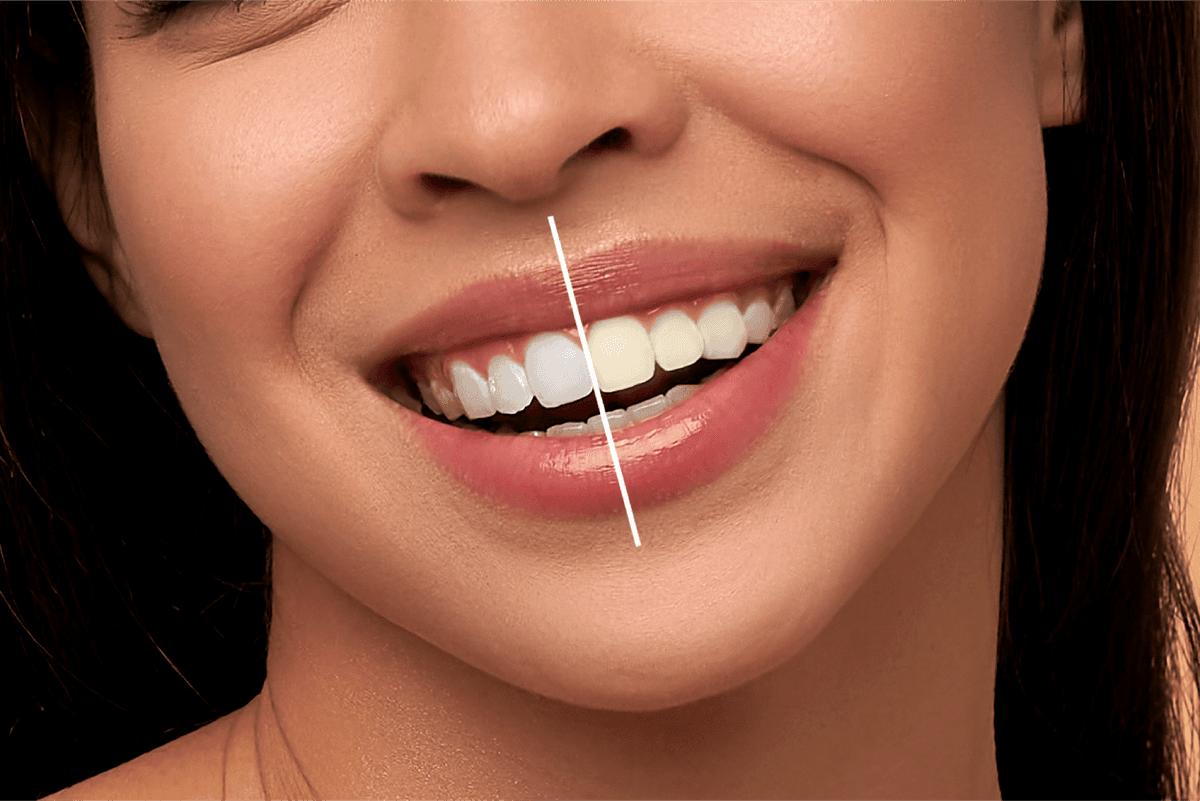 Professional Teeth Whitening Transformation
