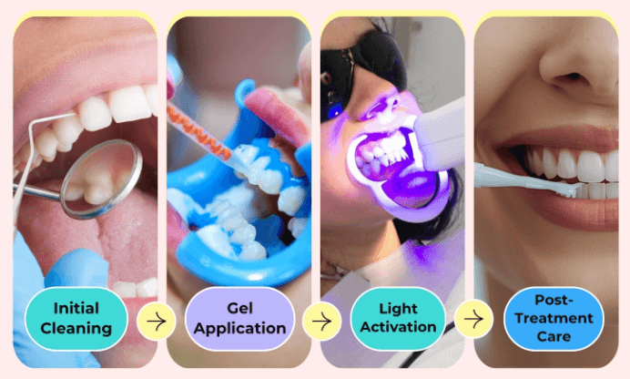 Professional Teeth Whitening Process