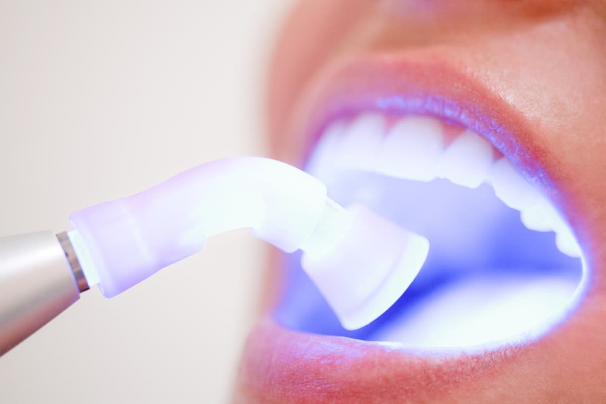 In-Office Teeth Whitening Procedure