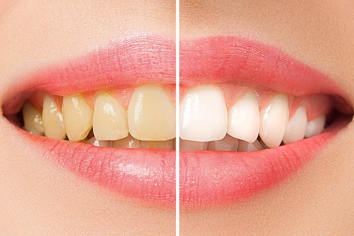 Maintaining Teeth Whitening Results