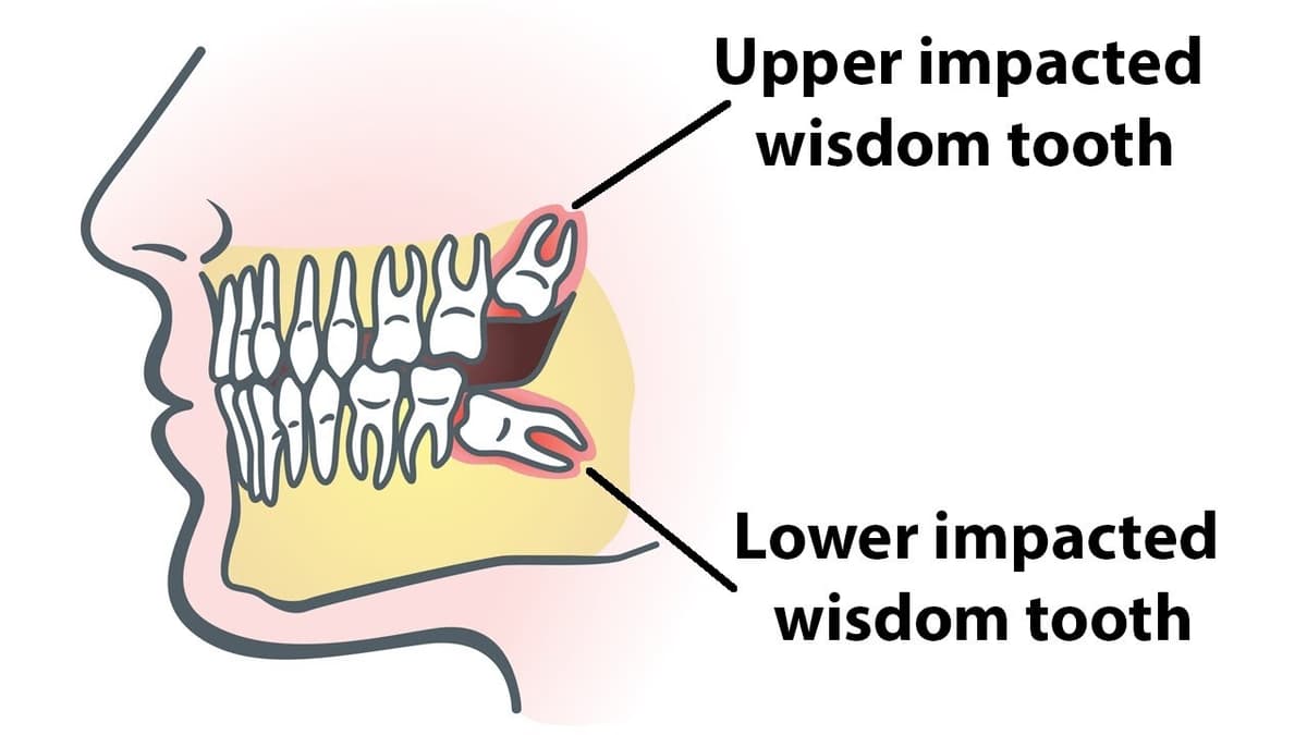 Wisdom Teeth Anatomy