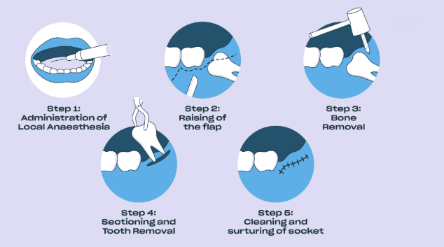 Wisdom Teeth Extraction Procedure