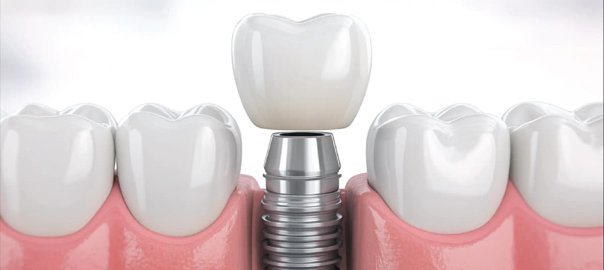 Dental Implant Illustration