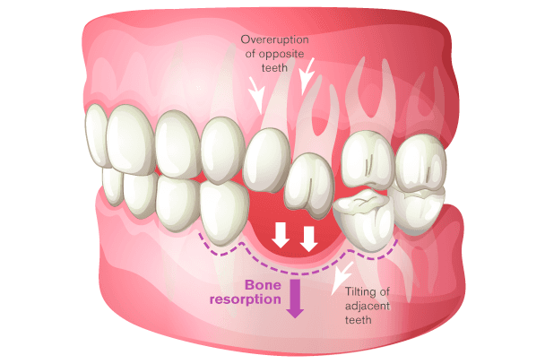 Dental Implant Illustration