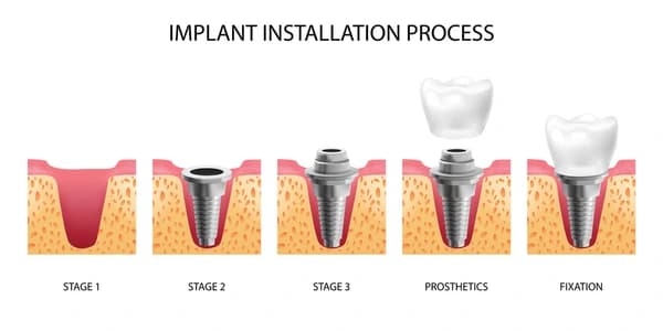 Dental Implant Illustration